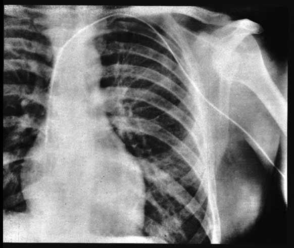 福斯曼醫師將心導管通到自己左心房後，用X-光拍的照片