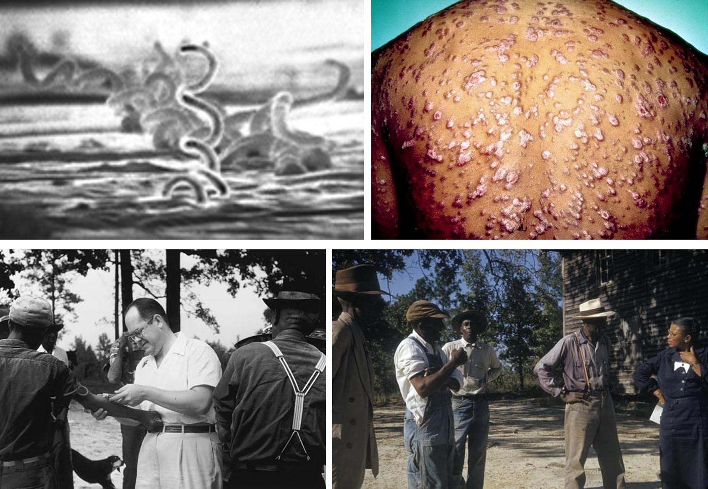 左上圖：梅毒螺旋體的電子顯微鏡圖；右上圖：第2期梅毒的全身性紅丘；左下圖：實驗者正在替受試者抽血，攝於1953年，此時抗生素已是標準療法，但政府從未想過要治療他們；右下圖：非洲裔的尤妮斯•禮薇斯(Eunice Rivers)護士正和受害者談話，禮薇斯擔任政府和受害者的溝通橋樑長達數十年，但她忽視拯救受害者的行為，飽受爭議。from: wikimedia & wikimedia